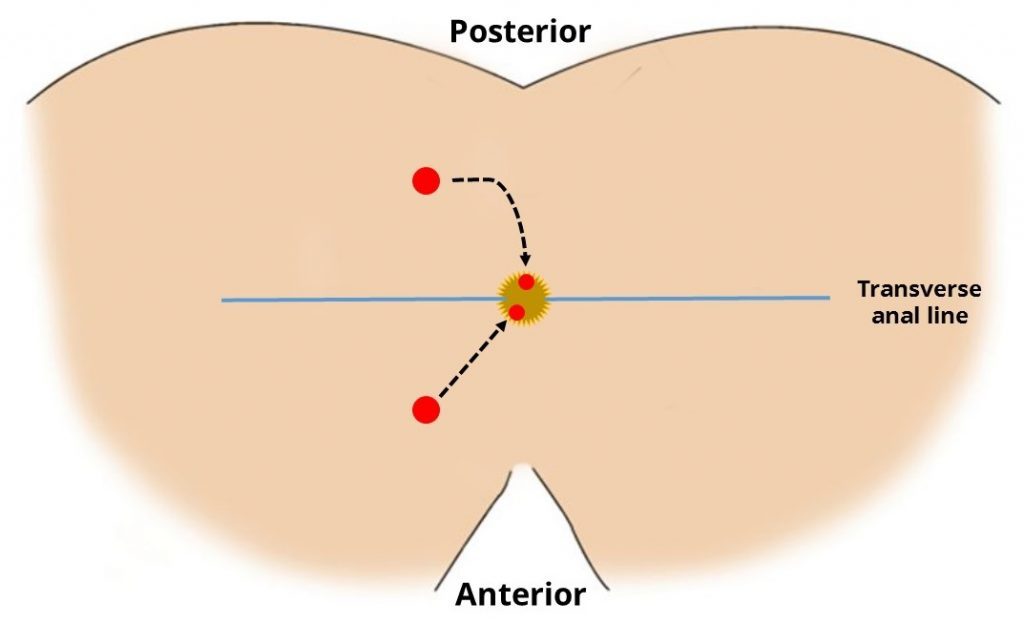 Fistula Treatment in Ghaziabad