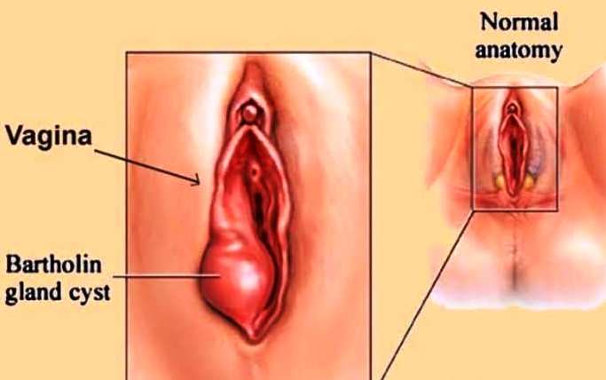 Bartholin's Cyst : Causes, Symptoms and Treatment - Ayurveda for your  Health