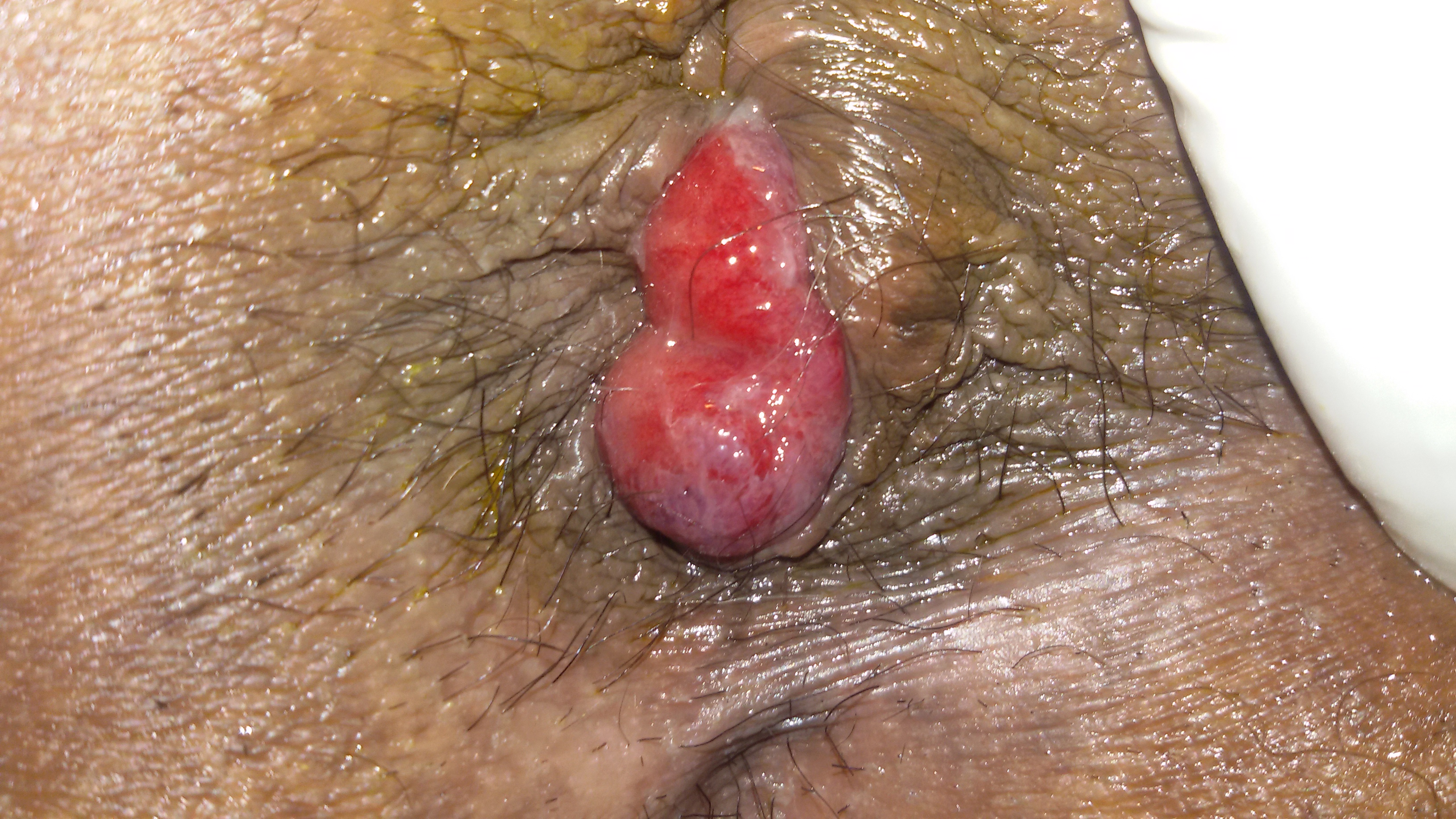 piles, hemorrhoids, bavaseer, arsh