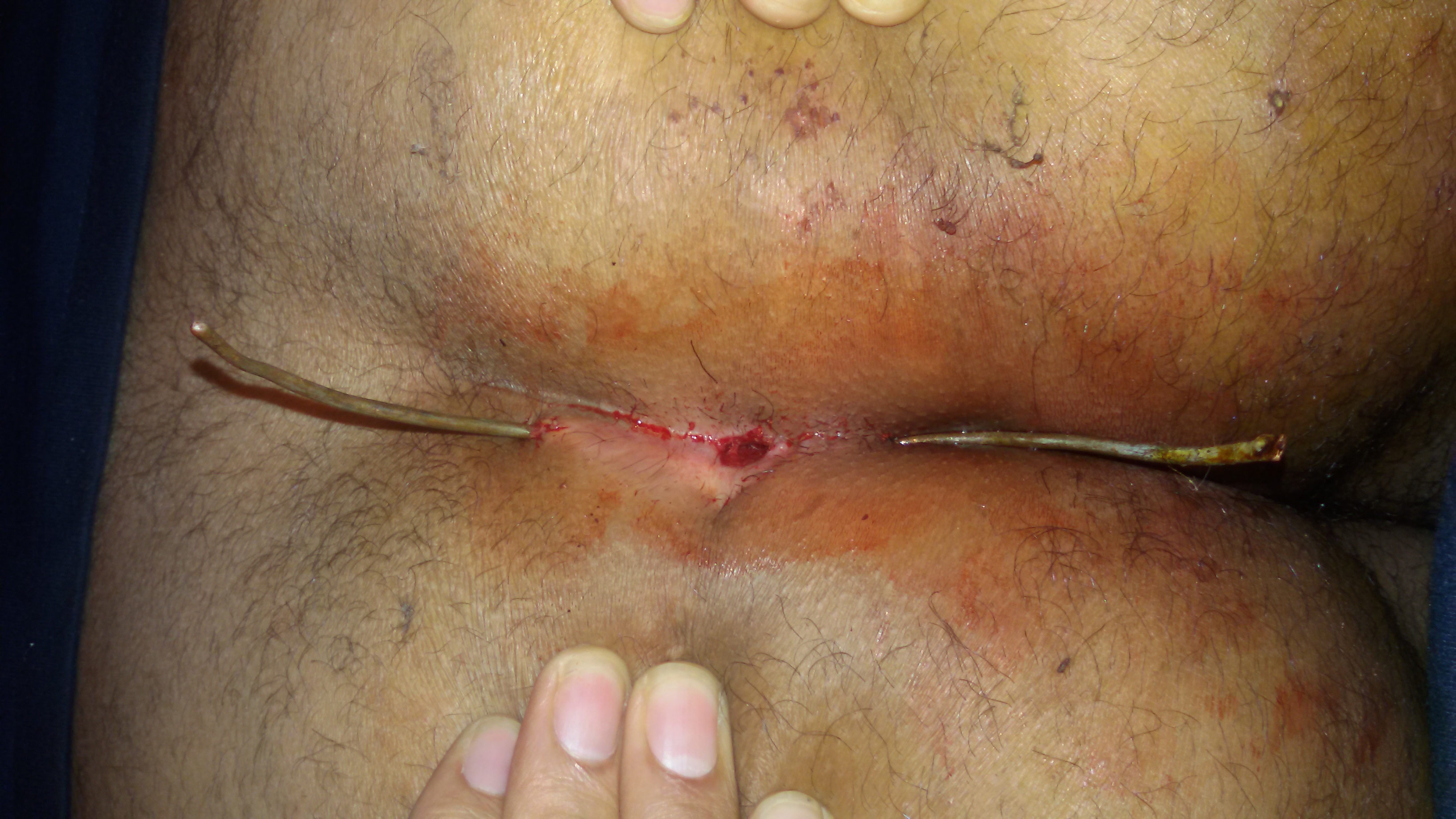 pilonidal sinus