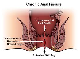 fissure