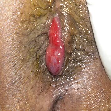 Piles (Hemorrhoids) Bavaseer  पाइल्स (बवासीर)