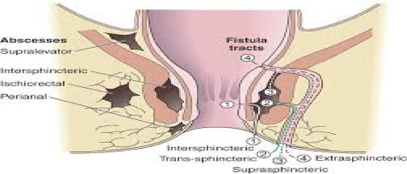 Fistula in ano (Bhagandar)  एनो (भगंदर) में फिस्टुला